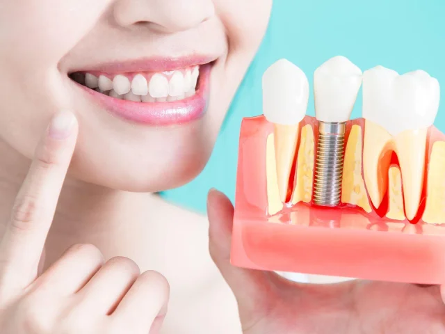 Dental İmplant Tedavisinde Merak Edilenler ve Avantajları
